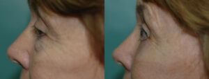 Patient 8d Blepharoplasty Before and After