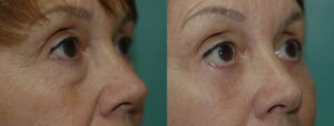 Patient 8c Blepharoplasty Before and After