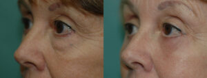 Patient 8b Blepharoplasty Before and After
