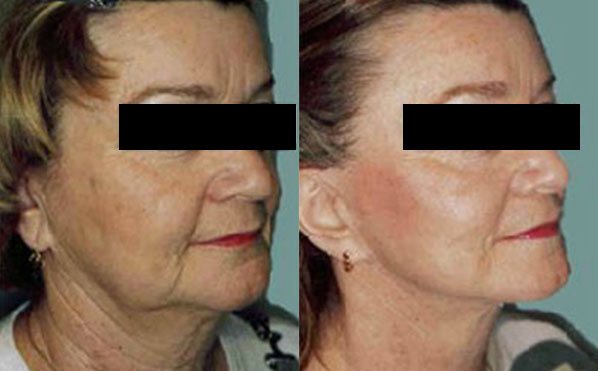Patient 5 Facelift Before and After