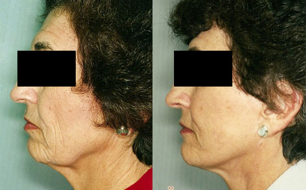 Patient 4 Facelift Before and After