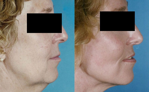Patient 3 Facelift Before and After