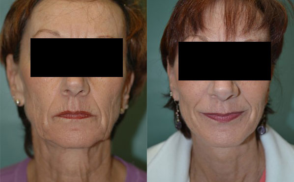 Patient 2 Facelift Before and After