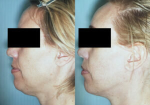 Patient 6c Facelift Before and After