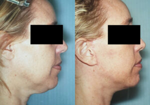 Patient 6b Facelift Before and After