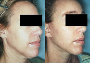 Patient 6a Facelift Before and After