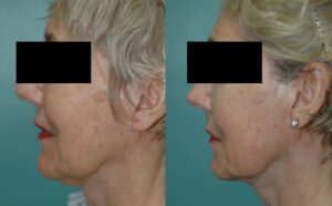 Patient 1b Facelift Before and After