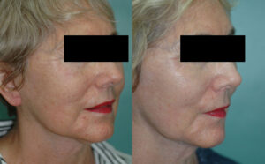 Patient 1c Facelift Before and After