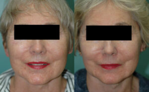 Patient 1a Facelift Before and After