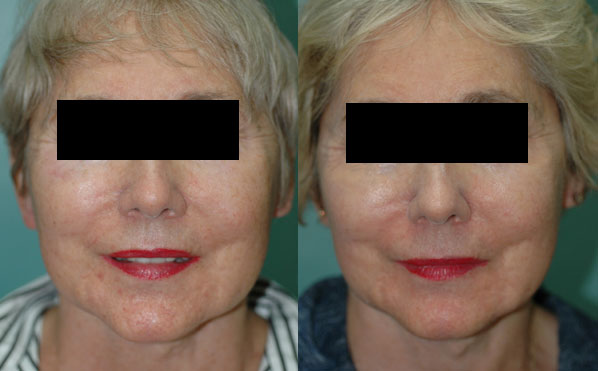 Patient 1a Facelift Before and After