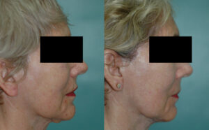 Patient 1d Facelift Before and After
