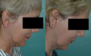 Patient 1e Facelift Before and After