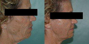 Patient 3d Micro Fat Grafting Before and After