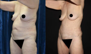 Patient 12b Tummy Tuck Before and After