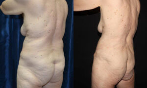Patient 12d Tummy Tuck Before and After