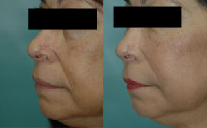 Patient 2c Micro Fat Grafting Before and After