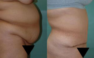 Patient 7c Tummy Tuck Before and After