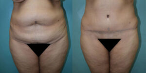 Patient 6b Tummy Tuck Before and After