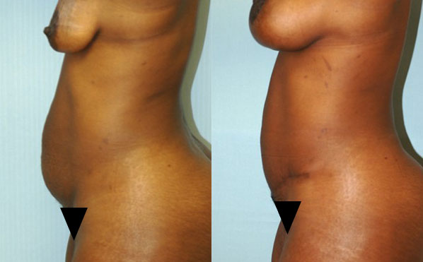 Patient 2 Tummy Tuck Before and After