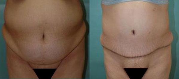 Patient 8a Tummy Tuck Before and After