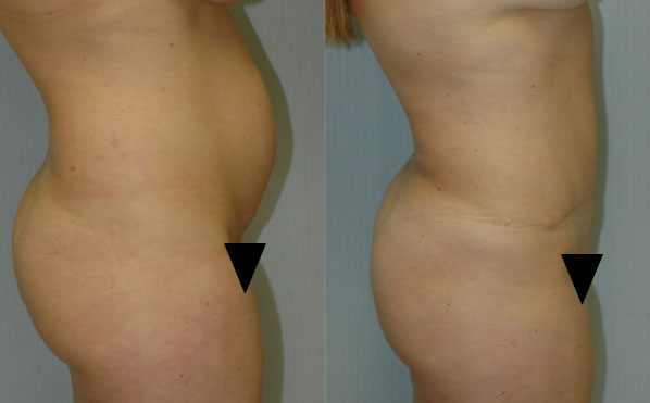 Patient 1 Tummy Tuck Before and After