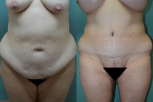Patient 5b Tummy Tuck Before and After
