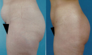 Patient 4 Liposuction Before and After