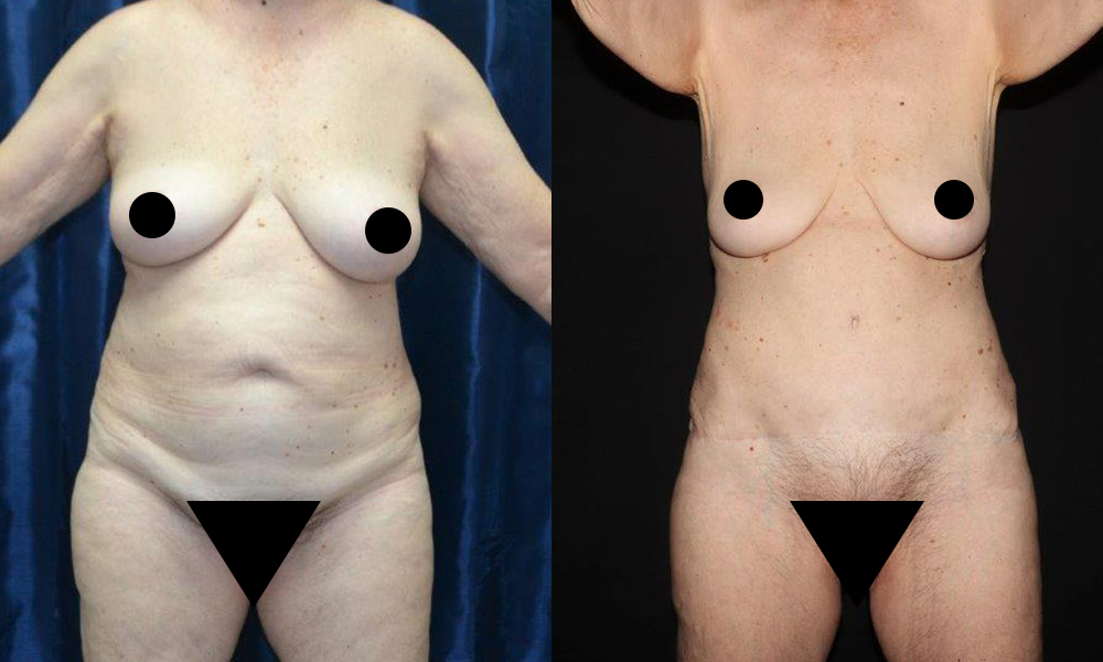 Patient 7a Liposuction Before and After