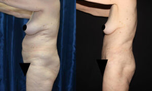 Patient 7c Liposuction Before and After