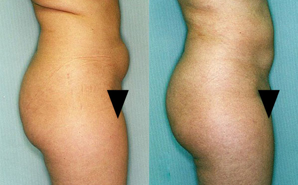 Patient 3 Liposuction Before and After