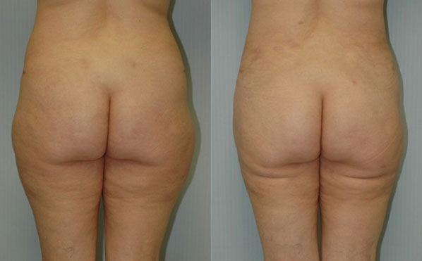 Patient 1 Liposuction Before and After