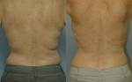 Patient 2 Liposuction Before and After
