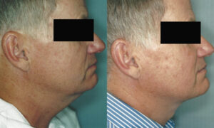 Patient 2a Neck Lift Before and After
