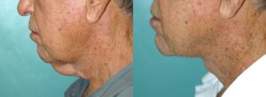 Patient 1b Neck Lift Before and After