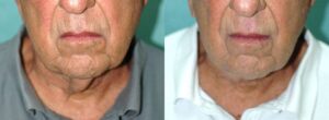 Patient 1a Neck Lift Before and After