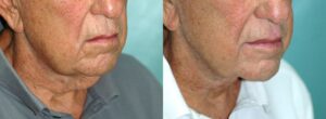 Patient 1d Neck Lift Before and After