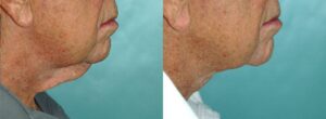 Patient 1e Neck Lift Before and After