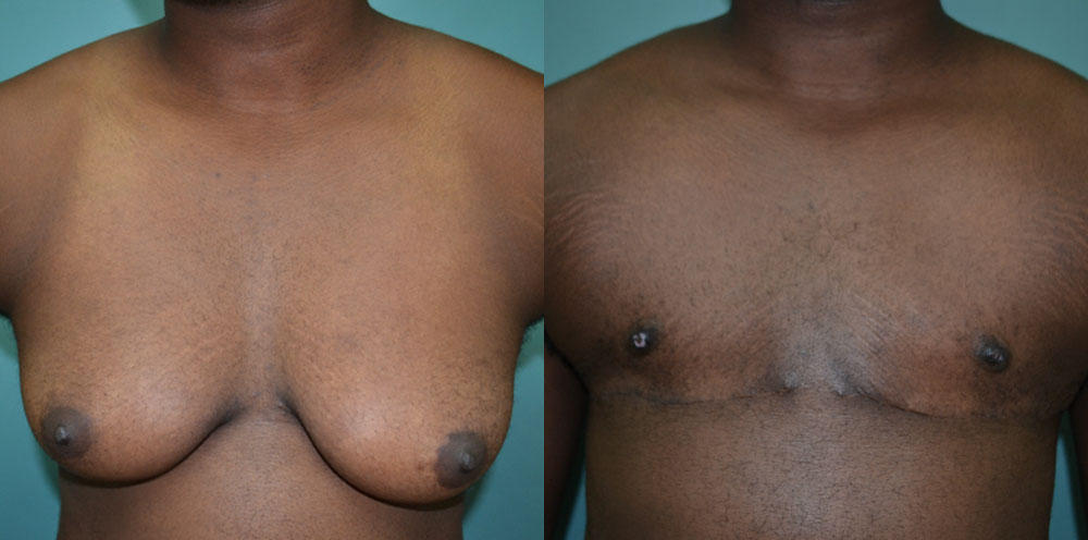 Patient 1a Transgender Plastic Surgery Before and After