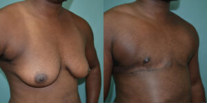 Patient 1c Transgender Plastic Surgery Before and After