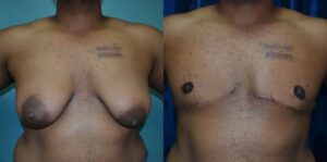 Patient 4 Transgender Plastic Surgery Before and After