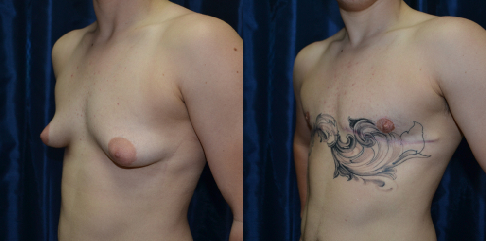Patient 5a Transgender Plastic Surgery Before and After