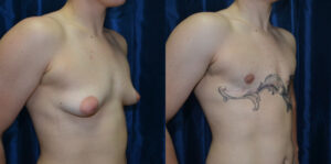 Patient 5d Transgender Plastic Surgery Before and After