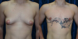 Patient 5e Transgender Plastic Surgery Before and After