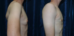 Patient 6a Transgender Plastic Surgery Before and After