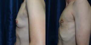 Patient 6b Transgender Plastic Surgery Before and After