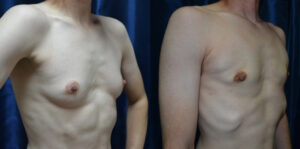 Patient 6c Transgender Plastic Surgery Before and After