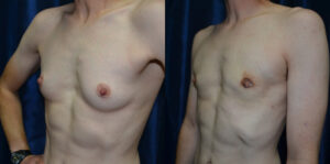 Patient 6d Transgender Plastic Surgery Before and After