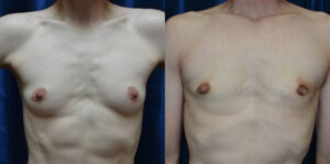 Patient 6e Transgender Plastic Surgery Before and After