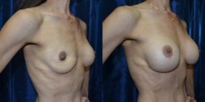 Patient 2a Breast Revision Before and After