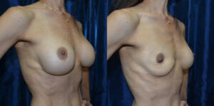 Patient A Breast Revision Before and After View 4